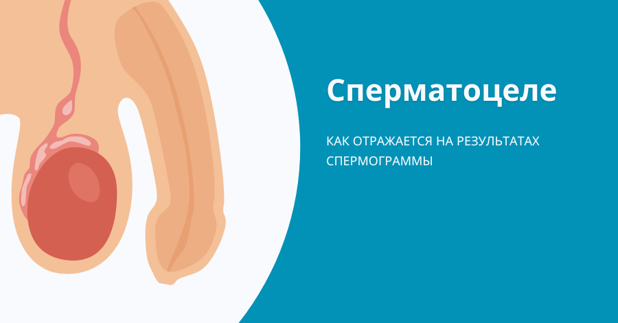 как сперматоцеле ухудшает спермограмму